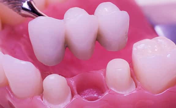 Dental Crowns in Roswell Georgia