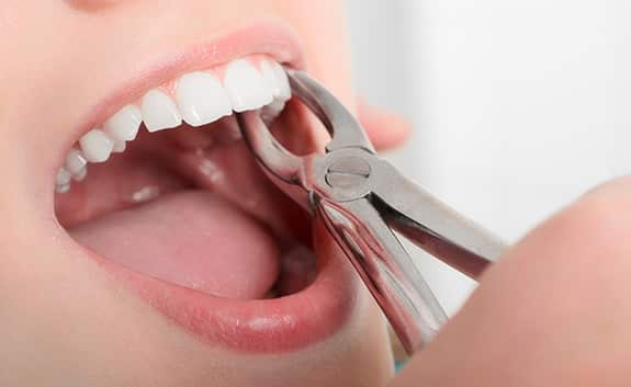 Dental Extractions - Oral Surgery in Roswell GA