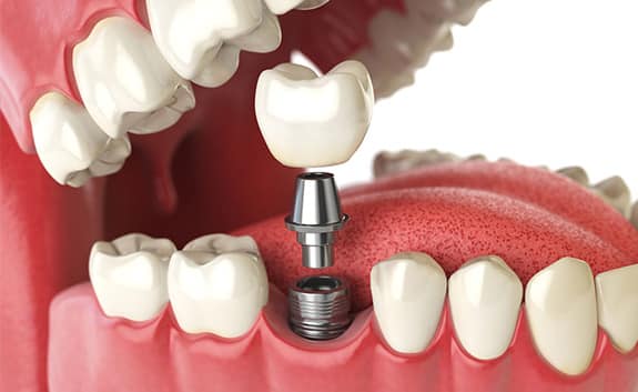 Dental Implants in roswell ga