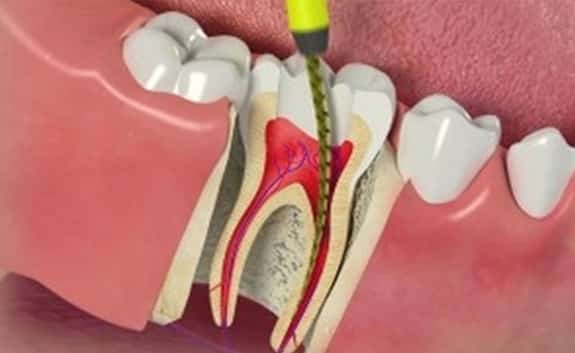 Endodontist in Roswell GA - Root canal Treatments