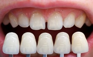 Dental Veneers in Roswell GA