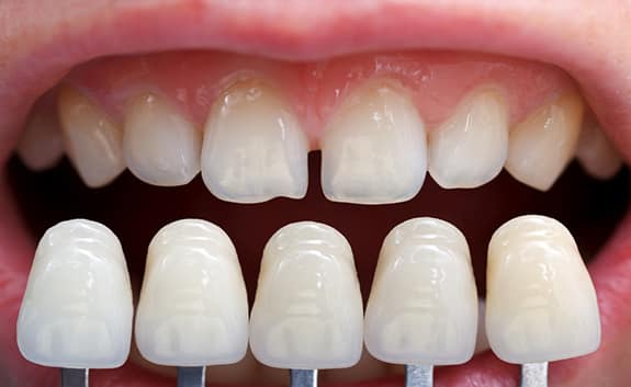 Dental Veneers in Roswell GA