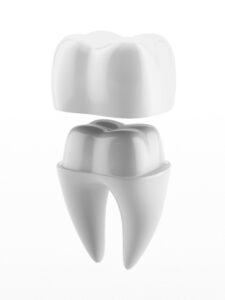 Dental Crowns in Roswell Gerogia - Sunshine Smiles Dentistry - Dentist Roswell GA - 365 Market Place ste 100, Roswell, GA 30075