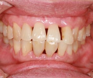 Receding gums - cases and treatment. At Sunshine Smiles Dentistry- Marietta Roswell Dental Care
