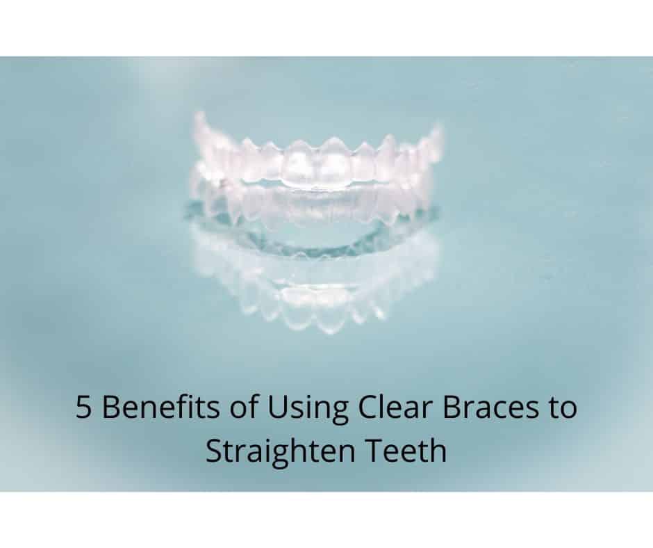 5 Benefits of Using Clear Braces to Straighten Teeth