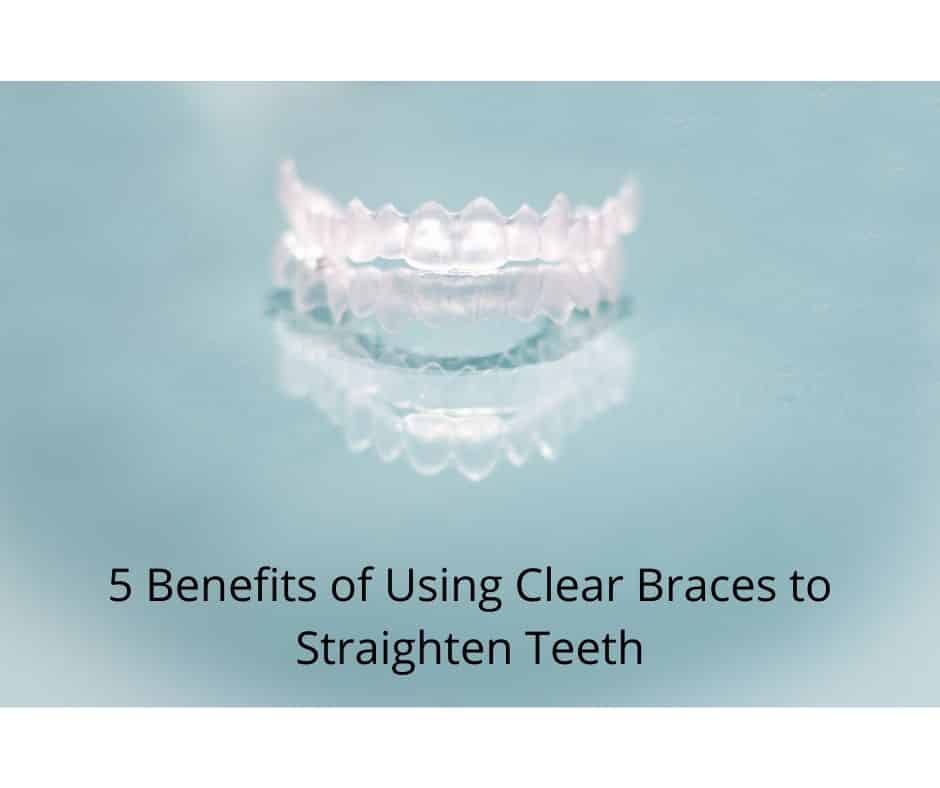 5 Benefits Of Using Clear Braces 