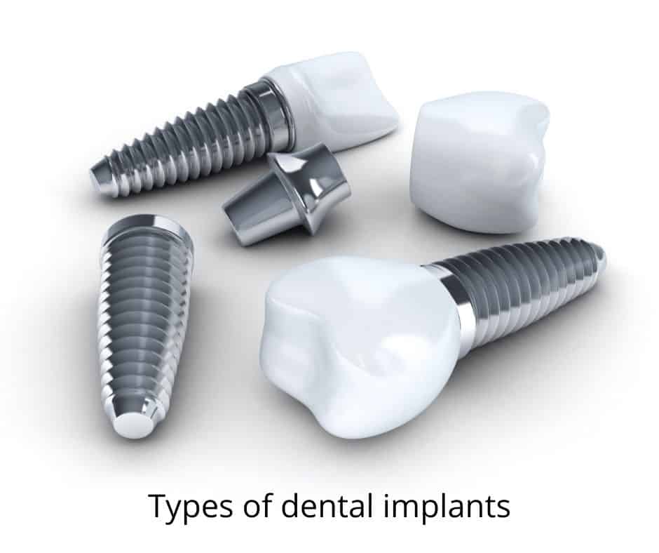 Types of dental implants - Sunshine Smiles Dentistry - Implant Dentist Roswell, Georgia