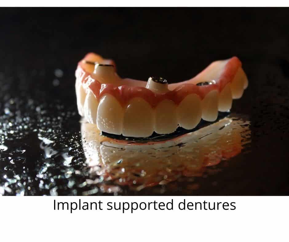Implant supported dentures - Local Roswell Dentist - Sunshine Smiles Dentistry