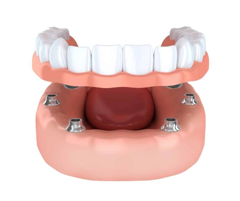 Smile with denture implants - Sunshine Smiles Dentistry - Denture Roswell Georgia