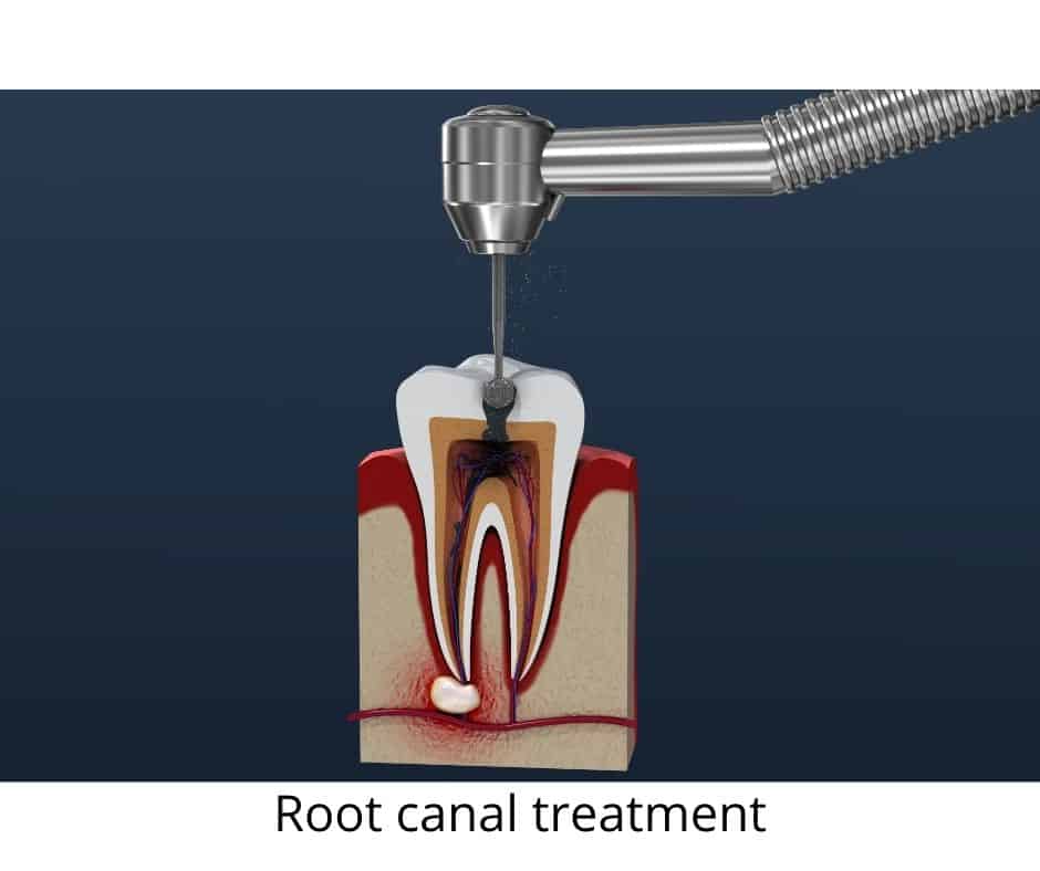 Root canal treatment - Dentist Roswell, GA - Sunshine Smiles Dentistry