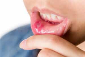 4 tips to avoid mouth ulcers - Dentist Roswell GA - Sunshine Smiles Dentistry - 365 Market Place ste 100, Roswell, GA 30075