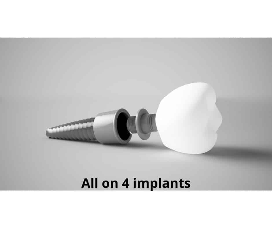 All on 4 implants - Sunshine Smiles Dentistry - Dentist Alpharetta GA