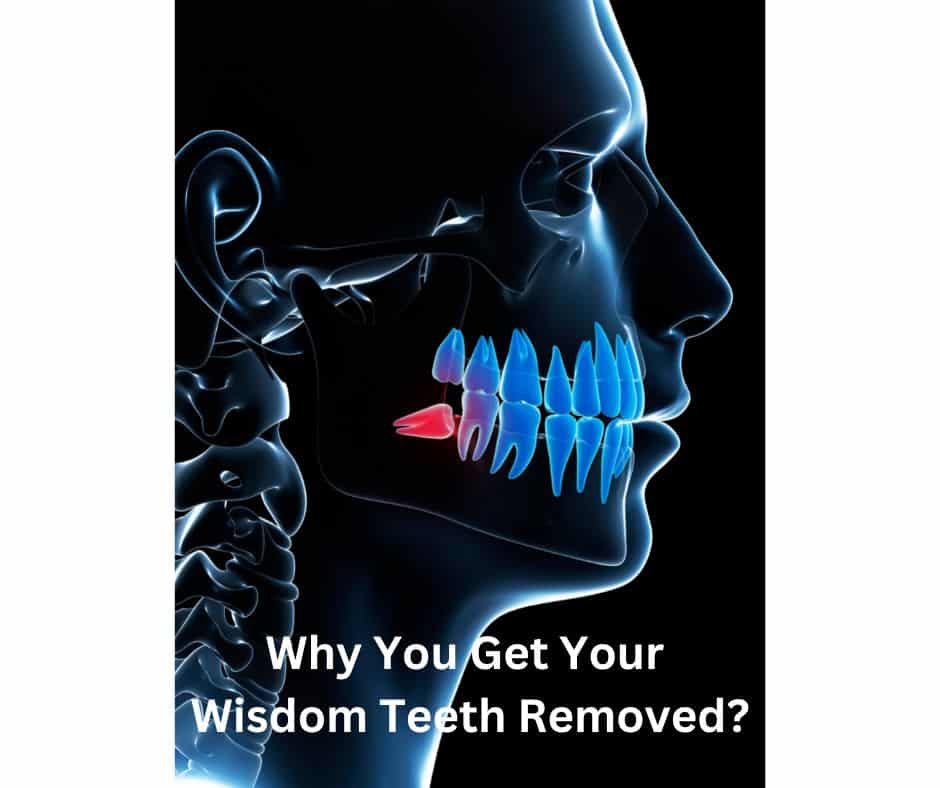 Why You Get Your Wisdom Teeth Removed - Sunshine Smiles Dentistry - Dentist Roswell GA