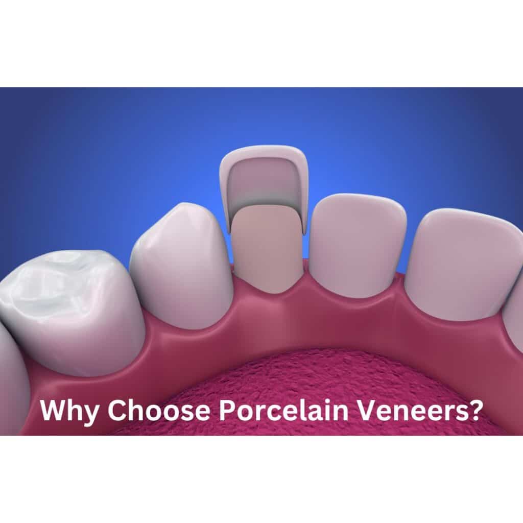 Why Choose Porcelain Veneers - Sunshine Smiles Dentistry - Dentist Roswell Georgia