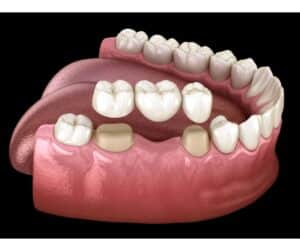Dental Bridge - Sunshine Smiles Dentistry - Roswell Dentist