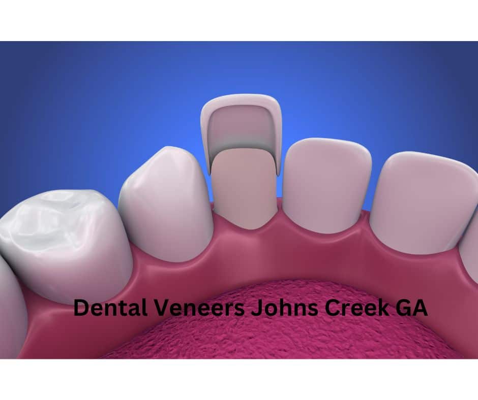 Dental Veneers Johns Creek GA - Sunshine Smiles Dentistry